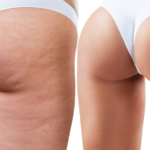 Perfect Body Cellulite recensioni – il modo migliore per combattere la cellulite
